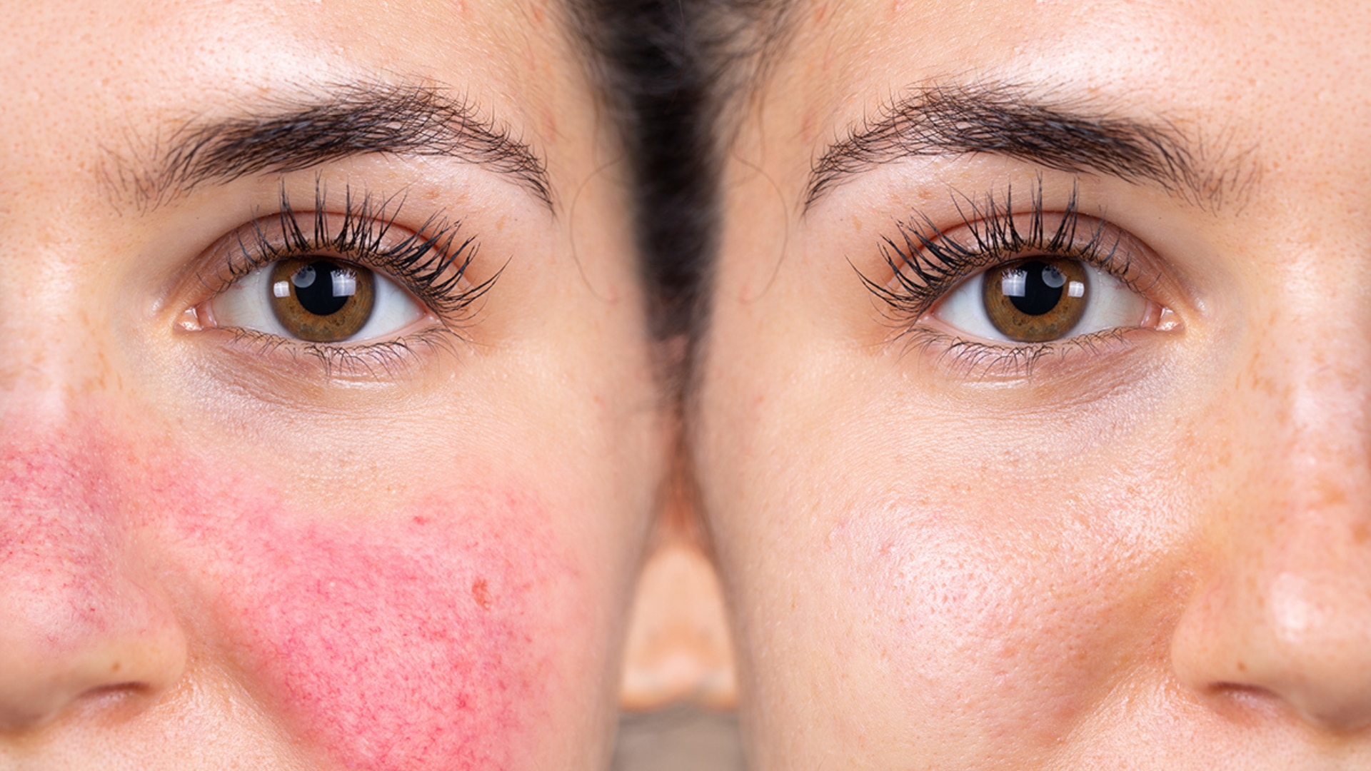 How Do You Remove Face Blood Vessels?