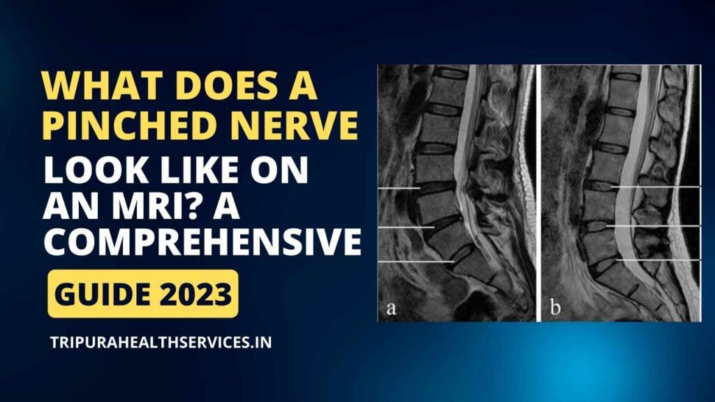 what does a pinched nerve look like on an mri