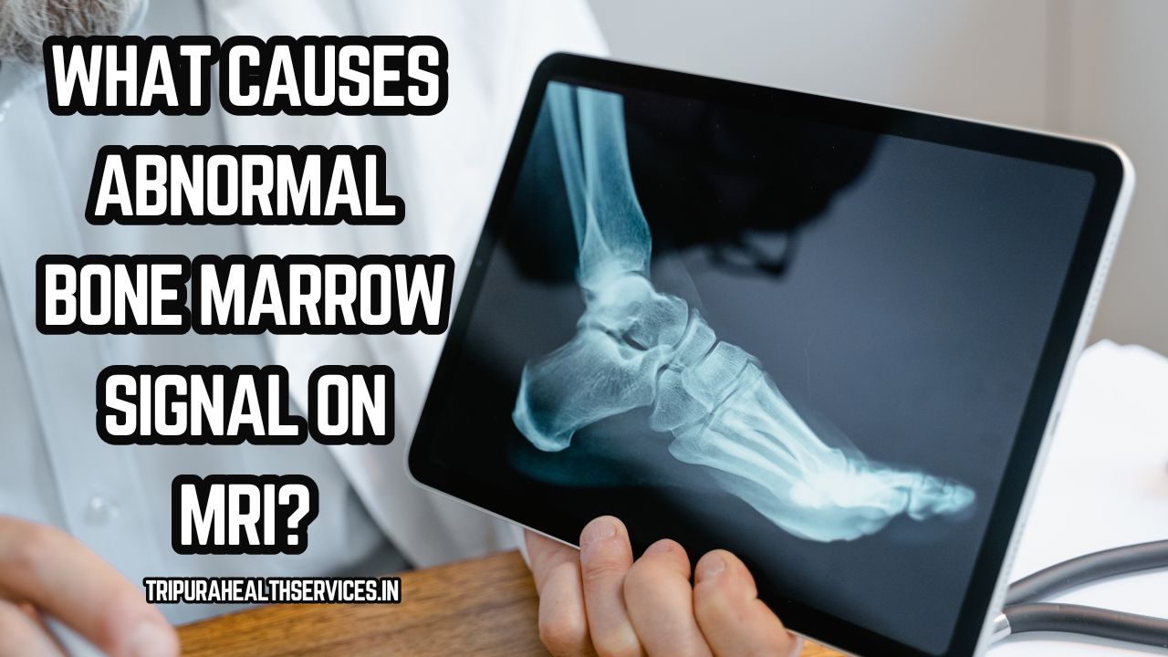 What Causes Abnormal Bone Marrow Signal on MRI: Unraveling the Underlying Causes